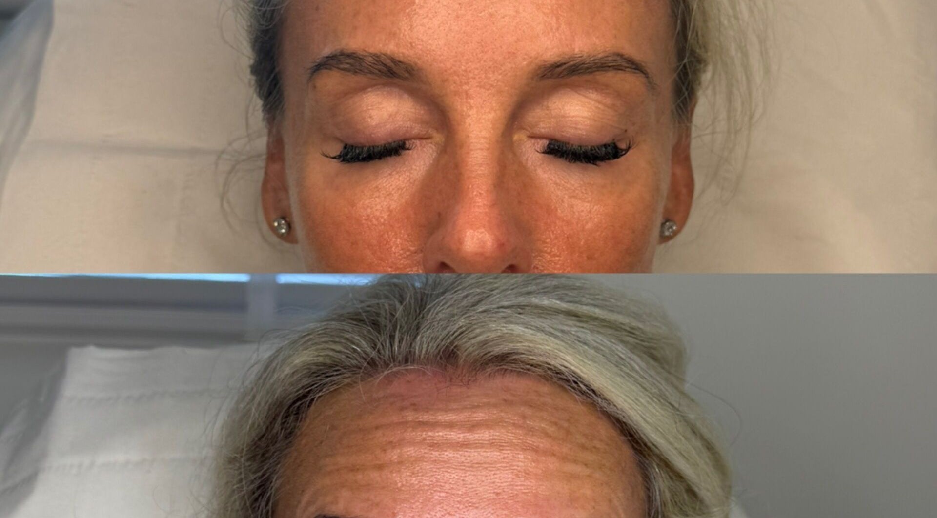 Before and after skin treatment at Reify Aesthetics, Chorley, England, GB, showing improved complexion.