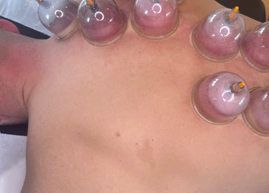 Cupping therapy session at KK Clinic, Ashby-de-la-zouch, England, GB, showing cups on a client's back.