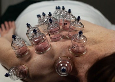 Cupping therapy at Harmonious Bliss Medical Massage & Life Coaching in Nocatee, Florida, US.