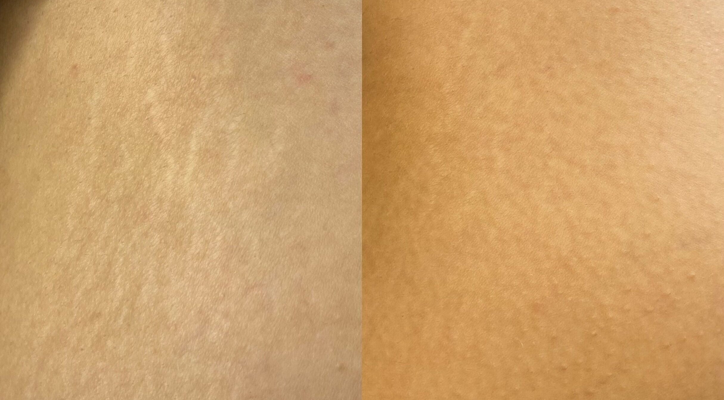 Huidverbetering behandeling bij Lima in Oostkamp, Vlaams Gewest, BE toont voor-na resultaten.