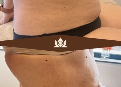 Resultado de tratamento estético em Eblime (Sabrina Barboza), Sintra, Lisboa, PT: antes e depois visíveis.