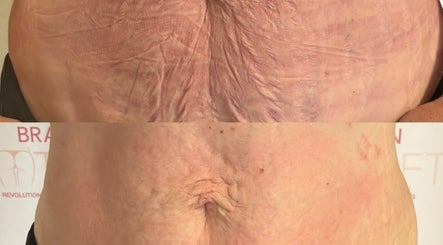 La Body in Derby, England showcases an amazing skin transformation with effective treatment before and after results.