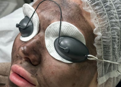 Laser facial treatment at KN The Brow and Laser Lab in Ossett, England, GB, featuring protective eyewear.