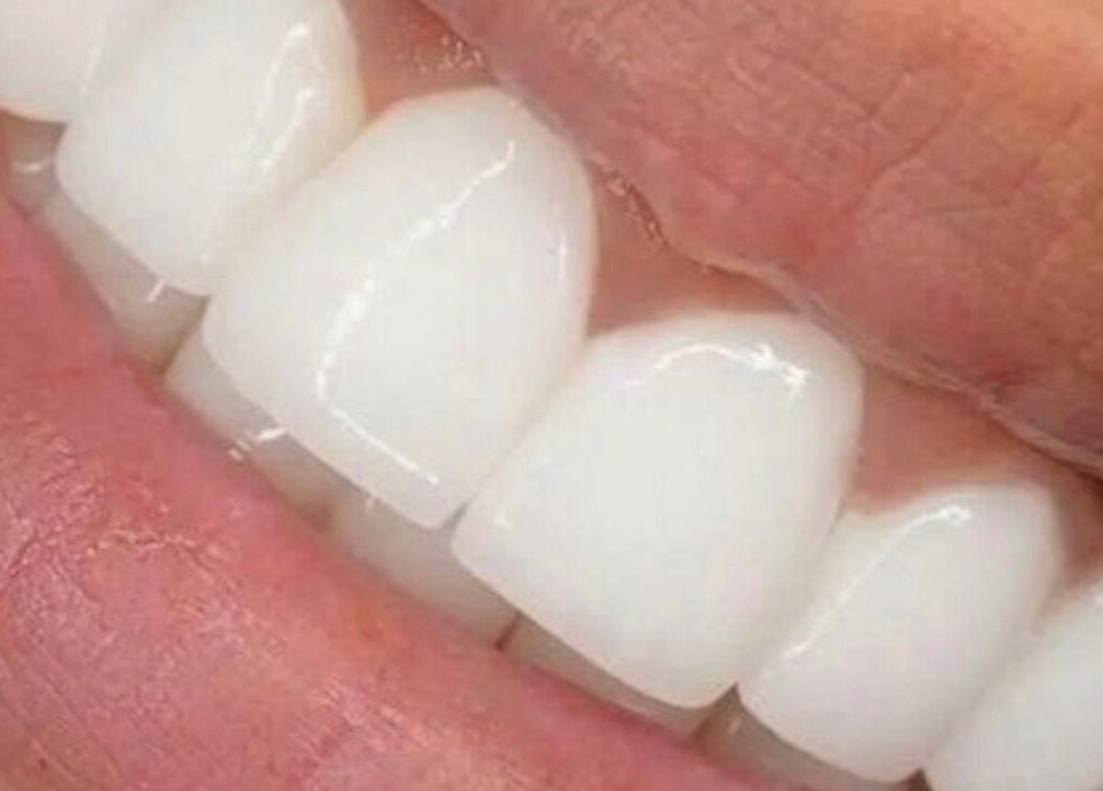 Bright, healthy teeth exemplifying services at The Whitening House, Salford, England, GB.