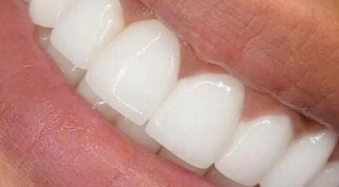 Bright, healthy teeth exemplifying services at The Whitening House, Salford, England, GB.
