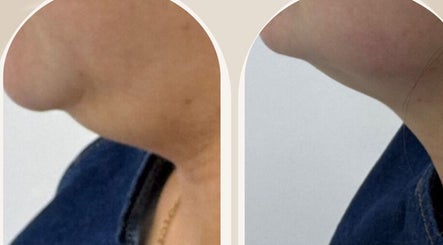 Before-and-after chin enhancement at ELITE BY KB, London / Walsall, GB, showcasing smooth contours.