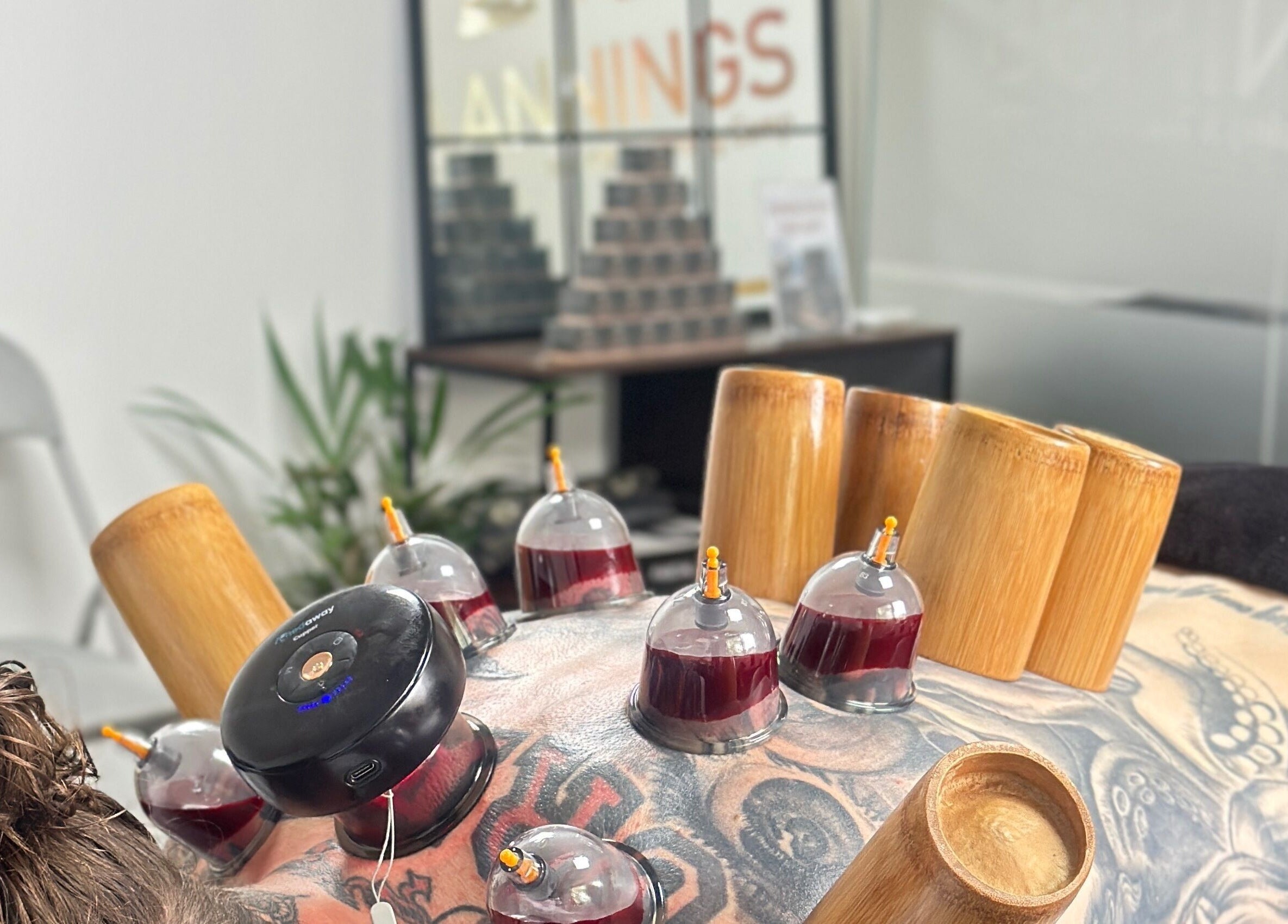 Cupping therapy session at Momentum ST, Birmingham, England, GB, showcasing innovative wellness practices.