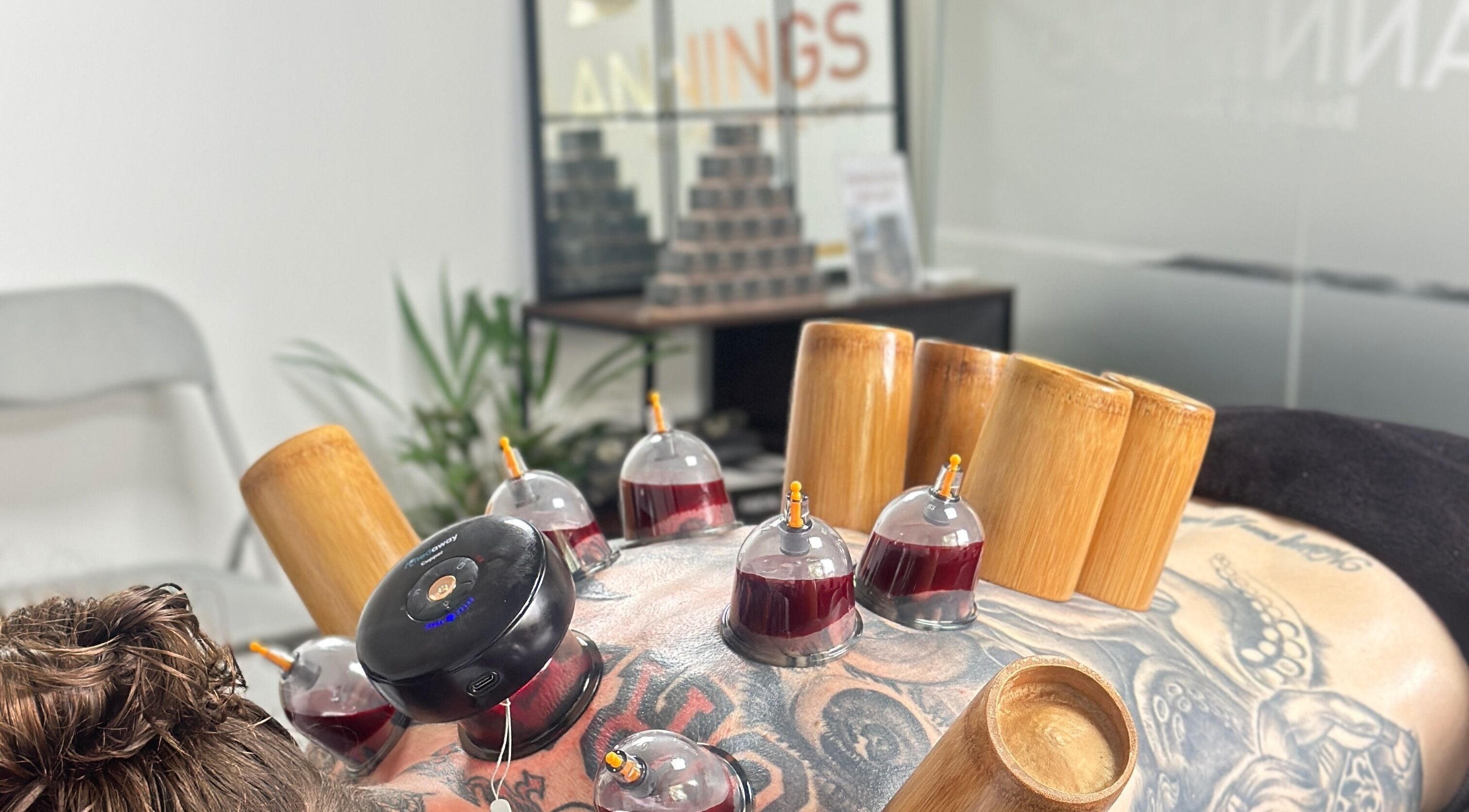 Cupping therapy session at Momentum ST, Birmingham, England, GB, showcasing innovative wellness practices.