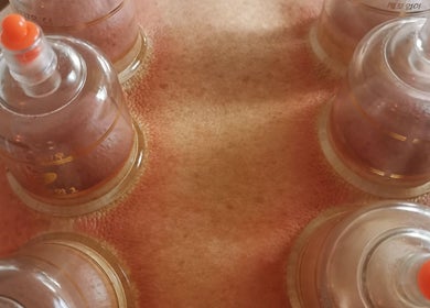 Cupping therapy at Eivissa Wellbeing, Lancaster, England, GB enhances relaxation and wellness.
