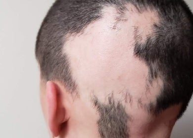 Back view of a man's head showing hair loss treated at CURA, Trail, British Columbia, CA.