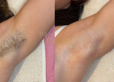 Before and after underarm waxing at The Waxing Room, Pencoed, Wales, GB. Noticeable hair removal results.