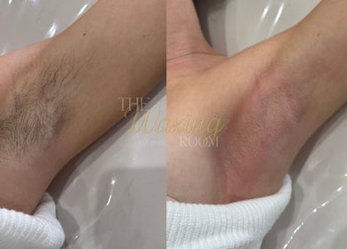 Underarm before and after waxing at The Waxing Room in Pencoed, Wales, GB. Noticeably smooth results.
