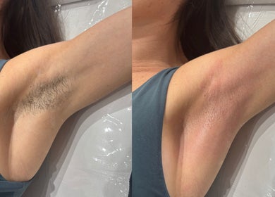 Before and after arm waxing at The Waxing Room, Pencoed, Wales, GB.