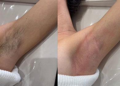Before and after armpit waxing at The Waxing Room, Pencoed, Wales, GB showing smooth skin result.