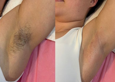 Before and after underarm waxing at The Waxing Room, Pencoed, Wales, GB.