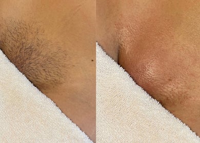 Before and after waxing results at The Waxing Room, Pencoed, Wales, GB, showcasing smooth skin.