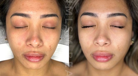 Before and after facial transformation at mnmlsm Beauty in Toronto, Ontario, CA showing improved complexion.