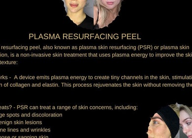 Plasma Resurfacing Peel at Skintelligence by Olivia Rose Louise, York, England. Non-invasive skin rejuvenation.