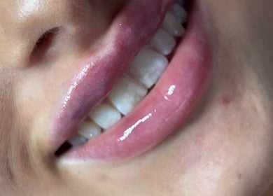 Close-up of beautifully enhanced lips at Angelic Aesthetics and Cosmetics, Canterbury, England, GB.