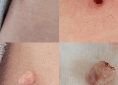 Close-up of skin treatments at Cupids Glow, Bolton, England, GB showcasing before and after results.