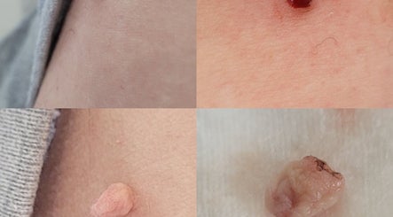Close-up of skin treatments at Cupids Glow, Bolton, England, GB showcasing before and after results.