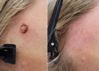 Close-up of a mole treatment at Cupids Glow, Bolton, England, GB, showing before and after results.