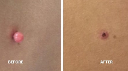 Before and after blemish treatment at Cupids Glow, Bolton, England, GB, showing clear skin results.