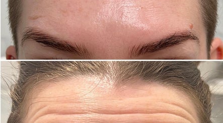 Forehead treatment before-and-after at Cupids Glow, Bolton, England, GB showing smooth skin results.