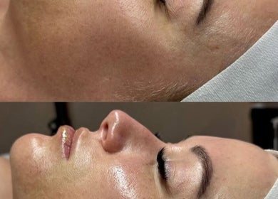 Before and after facial treatment at Cupids Glow, Bolton, England, GB, showcasing skin rejuvenation.