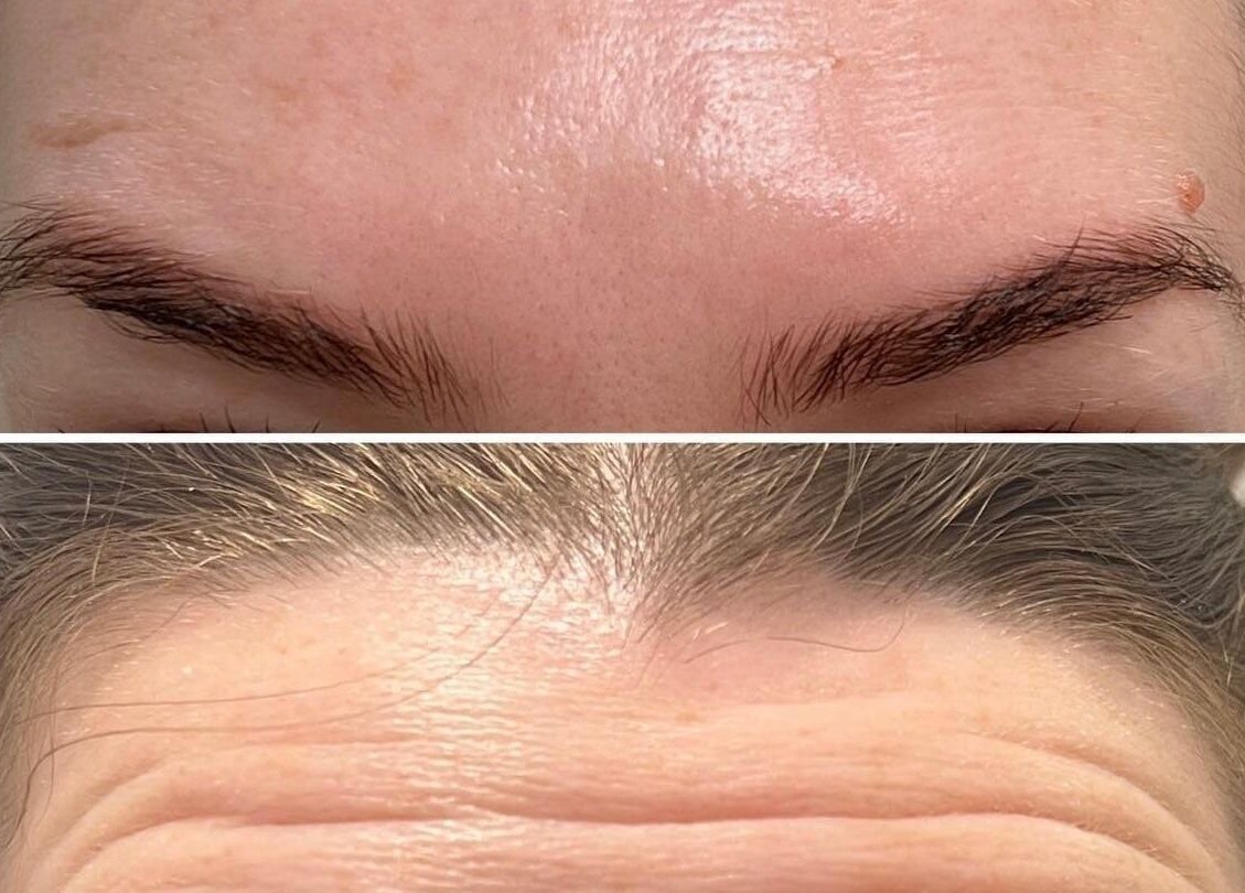 Before and after wrinkle treatment at Cupids Glow, Bolton, England, GB showcasing skin transformation.