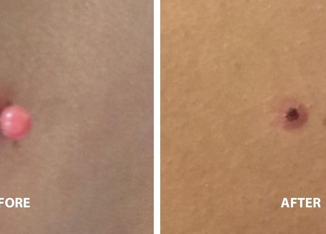 Before and after skin treatment at Cupids Glow, Bolton, England, GB, showcasing enhanced skin smoothness.