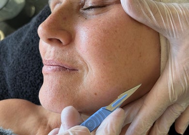 Close-up of dermaplaning treatment at Tips to Toes Nails & Beauty by Joanne, Great Yarmouth, England, GB.