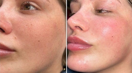 Before and after skincare results at DS Aesthetics, Dublin W, County Dublin, IE showing improved complexion.