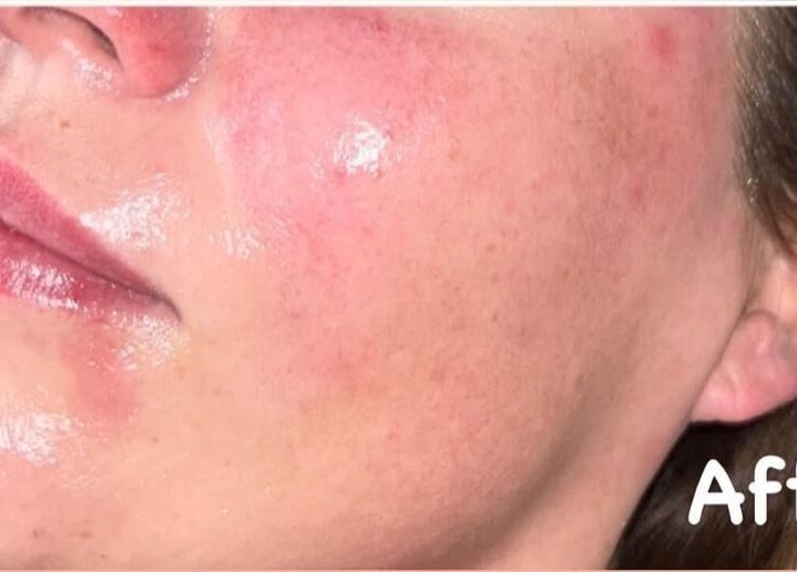 Smooth, glowing facial skin after treatment at DS Aesthetics, Dublin W, County Dublin, IE.