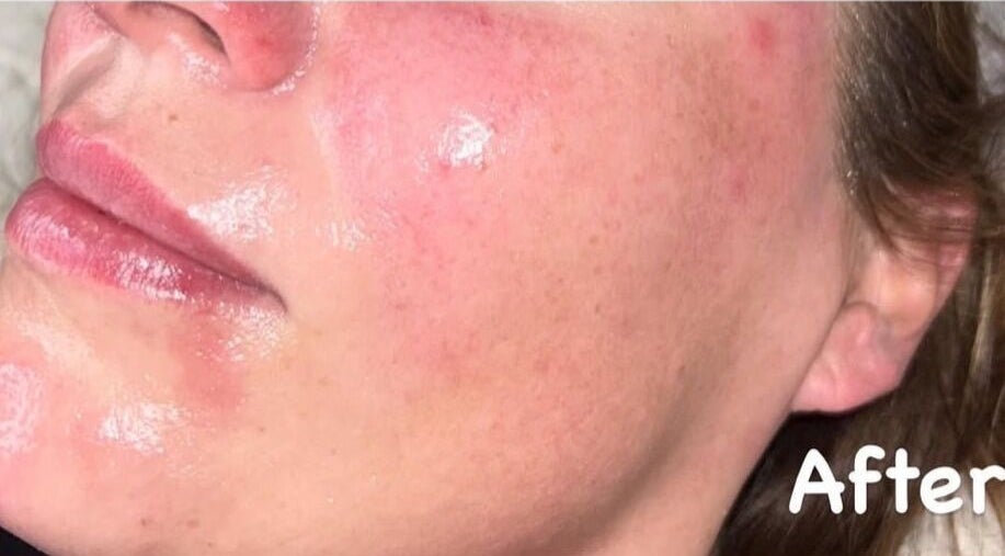 Smooth, glowing facial skin after treatment at DS Aesthetics, Dublin W, County Dublin, IE.