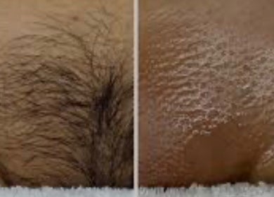Before and after hair removal at Beauty by Jen, Liverpool, England, GB.