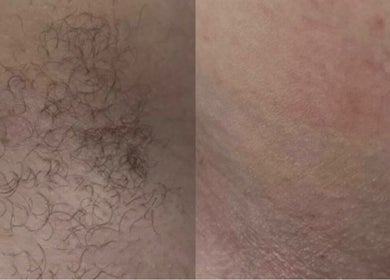 Before and after hair removal at Beauty by jen, Liverpool, England, GB showing smooth skin results.