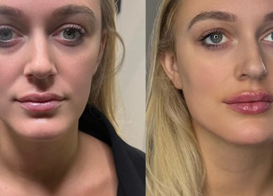 Before and after facial treatment at Aesthetic Nurse Marta, Vaughan, Ontario, CA. Notice the refined skin texture.