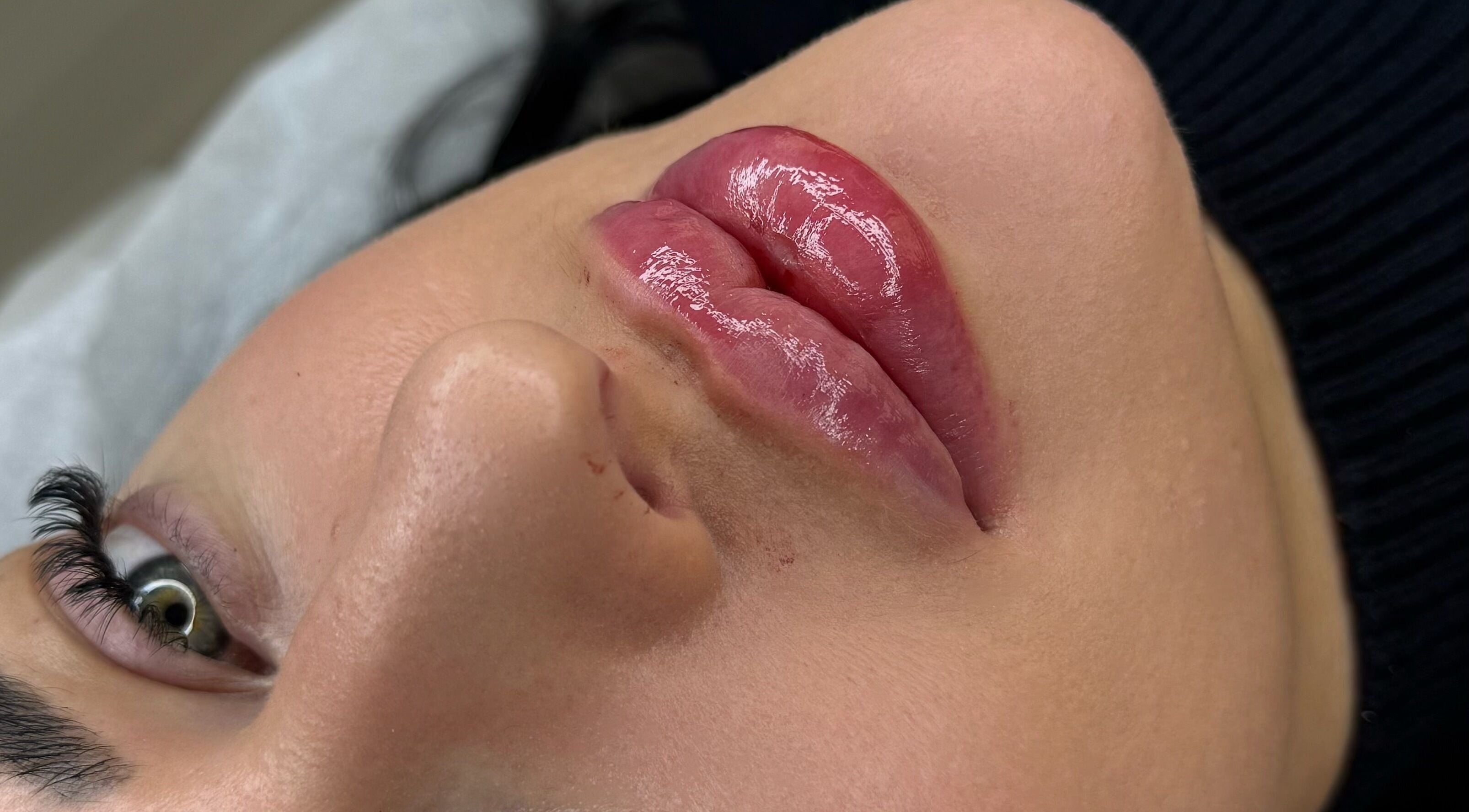 Close-up of glossy lips after treatment at Aesthetic Nurse Marta, Vaughan, Ontario, CA.