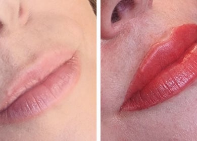 Lip enhancement before and after at Complete Beauty by Cathy, Neutral Bay, New South Wales, AU.