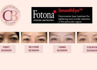 Progress of Fotona SmoothEye treatment at Complete Beauty by Cathy, Neutral Bay, New South Wales, AU.
