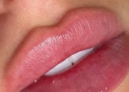 Close-up of enhanced lips, styled at Aesthetics by Kinga Jambor, Nottingham, England, GB.