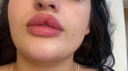 Beauty Fillers Dermal Aesthetics image 2