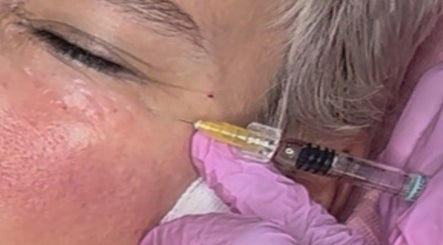 Beauty Fillers Dermal Aesthetics image 3