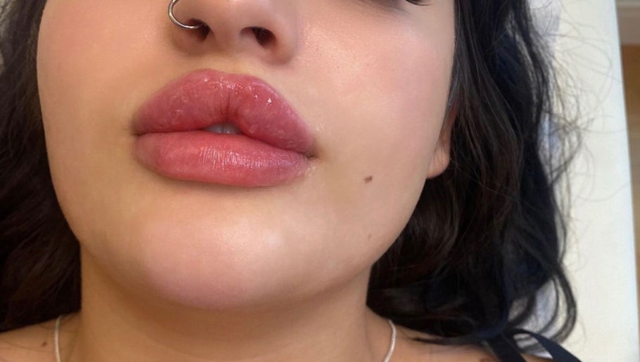 Gambar Beauty Fillers Dermal Aesthetics 1