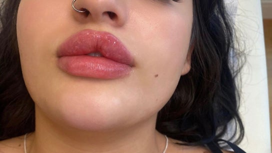 Beauty Fillers Dermal Aesthetics