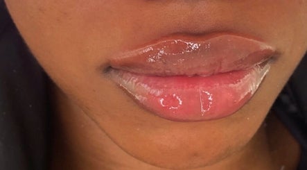 Gambar Beauty Fillers Dermal Aesthetics 3