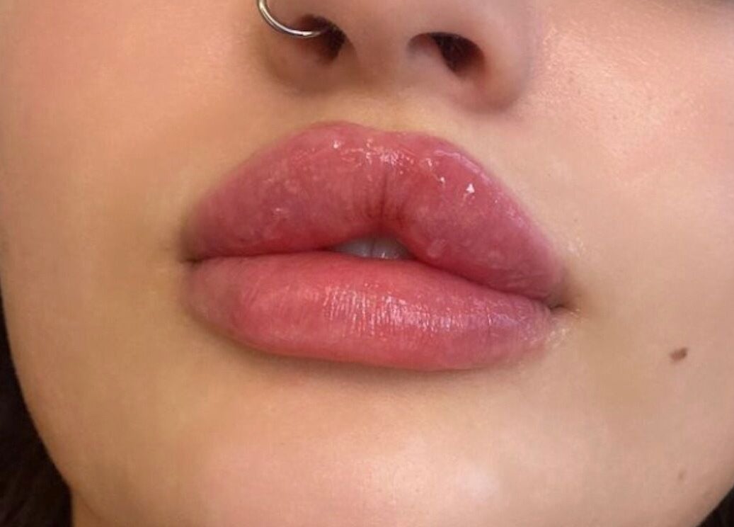Close-up of enhanced lips at Beauty Fillers Dermal Aesthetics, London, England, GB.