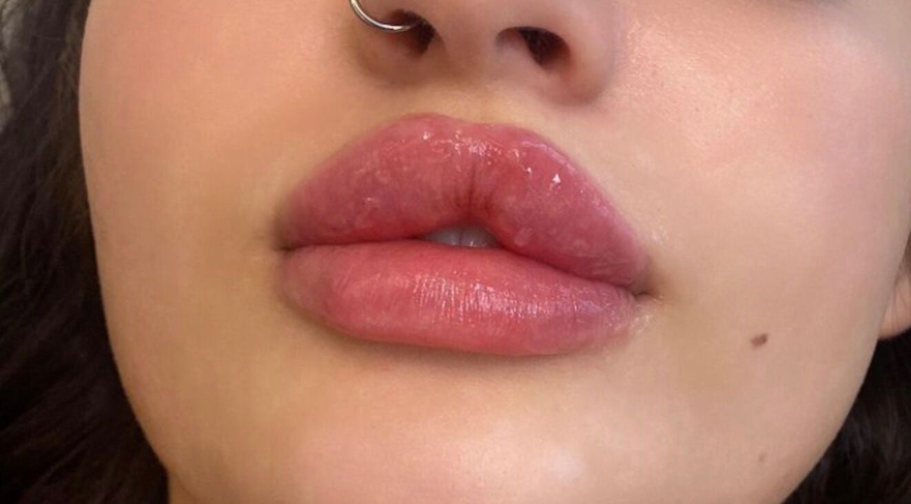 Close-up of enhanced lips at Beauty Fillers Dermal Aesthetics, London, England, GB.