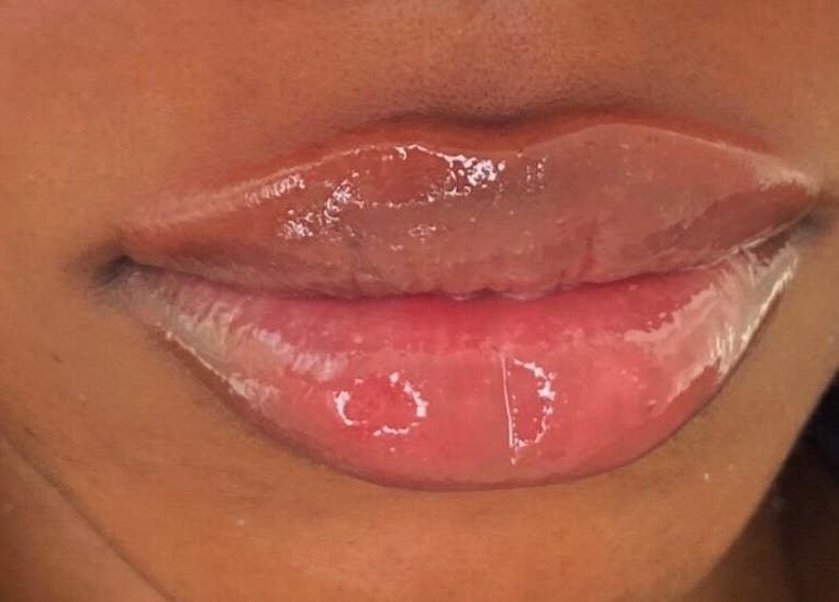 Close-up of glossy lips post-treatment at Beauty Fillers Dermal Aesthetics, London, England, GB.